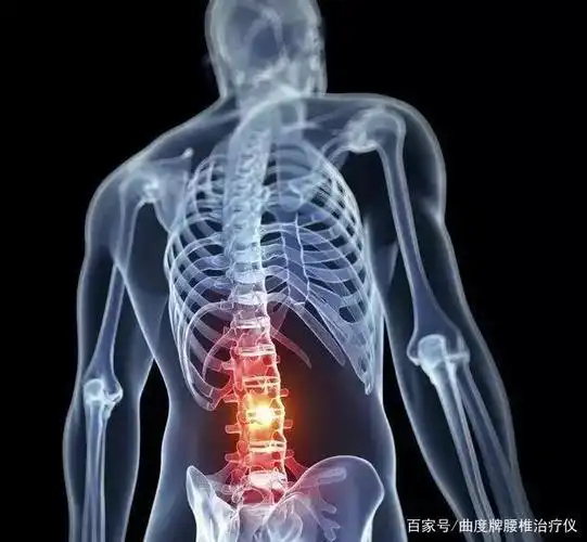 如果你认为腰椎间盘突出是老年人的问题,那就错了,据相关数据统计