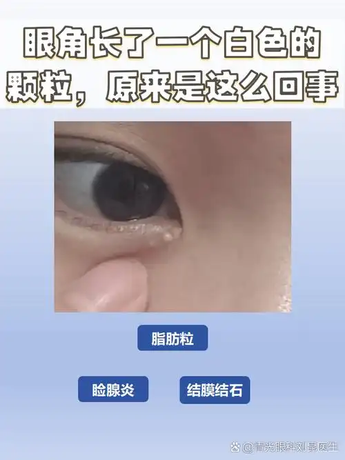 如果发现眼角长了一个白色的颗粒,这到底是怎么回事呢?