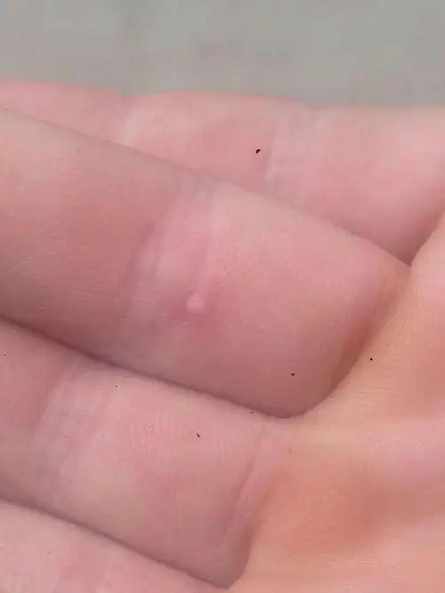 手上长了个白点点这是感染还是什么呢?