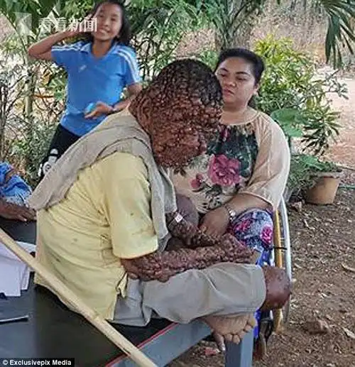 泰国男子患罕见病 全身长满泡泡状肿瘤睁眼都费劲