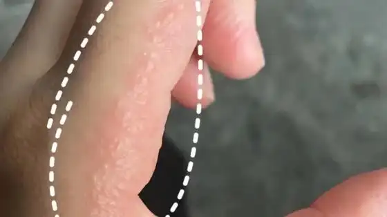 手上起透明小水泡,竟然是汗疱疹
