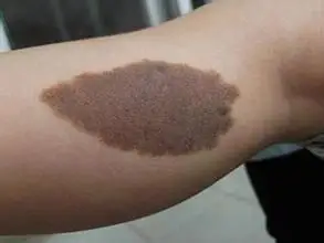 手臂胎记的位置与命运