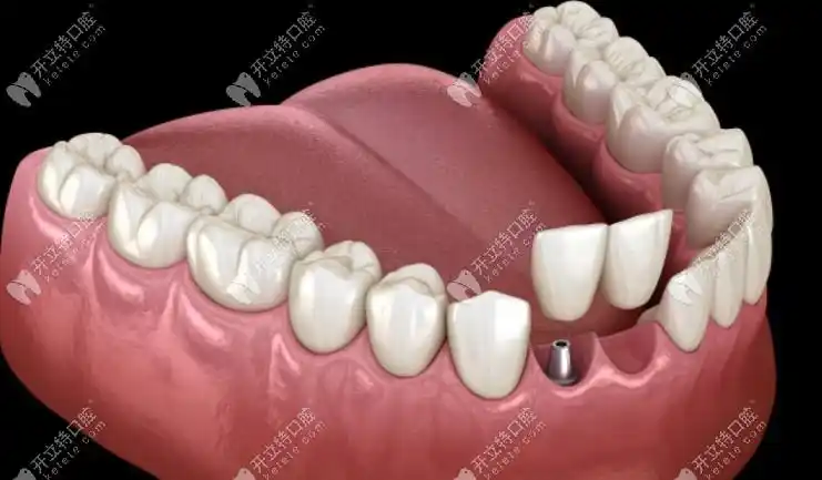 种植牙基台和牙冠是分开收费吗?基台牙冠占总费用比例是.