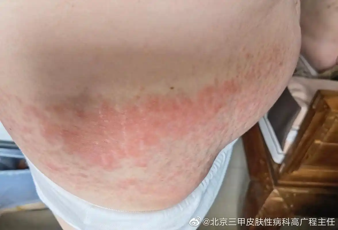 图片表现是过敏反应是湿疹.