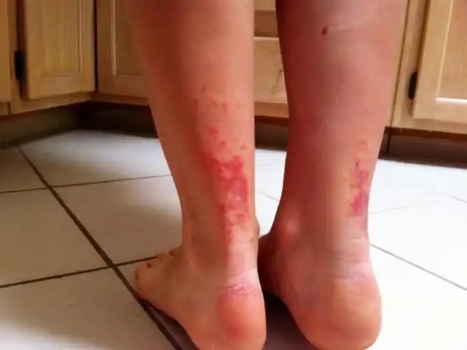 腿上长了很多小红点很痒