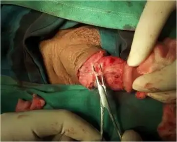 阴茎背神经阻断术治疗早泄?小心别被忽悠 | 手术图解