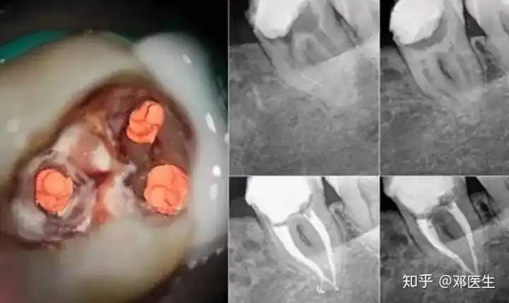 抽牙神经到底有多恐怖? - 知乎
