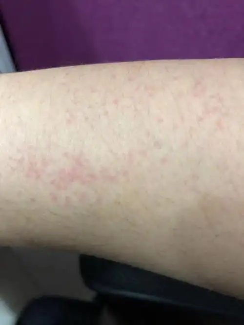 手臂长一小片红点不疼也不痒,一般上午冒出,两三个小时后就消散了!
