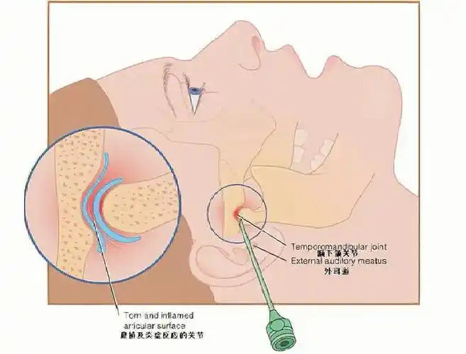 颞颌关节紊乱温州医科大学附属第一医院