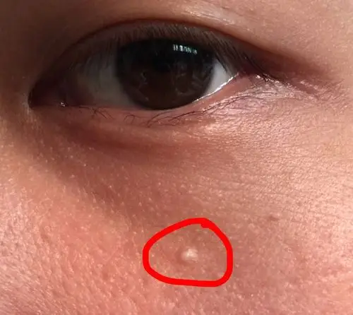 脸上很少长痘,半年前脸上长了这个白色的痘,不疼不痒一直不下去,请问