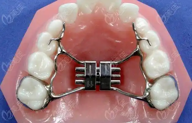 hass矫治器和mse骨性扩弓矫治器怎么选,上颌骨发育不足用谁更好