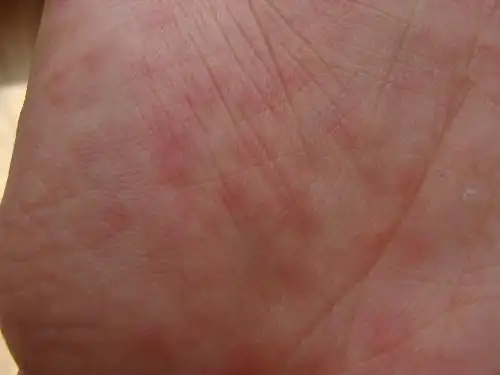 手掌出现红点是怎么回事(有图)?