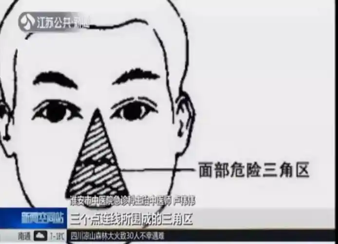 三角区的脓不挤怎么办 危险三角区脓点