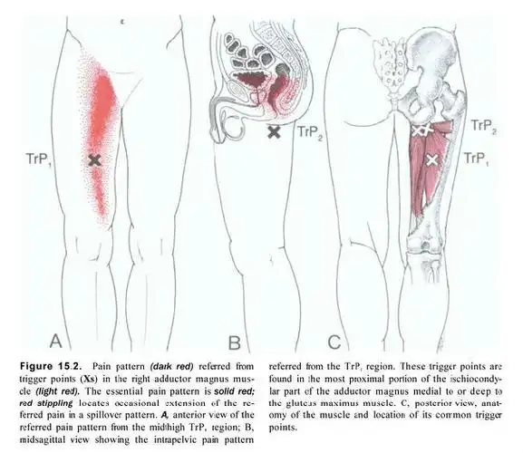 大腿内侧疼痛的肌筋膜激痛点松解治疗