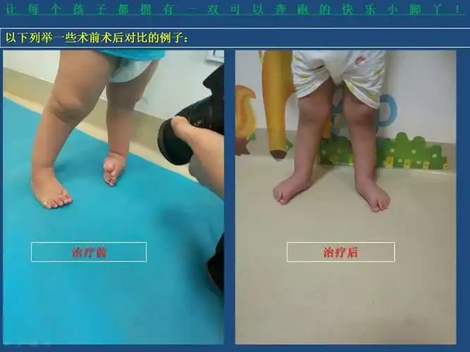 儿童先天性畸形之马蹄内翻足 - 好大夫在线