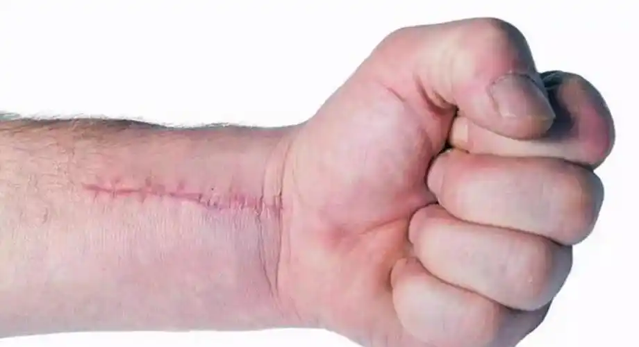 人体受伤后伤口是怎样愈合的?看完大开眼界,原来如此神奇!