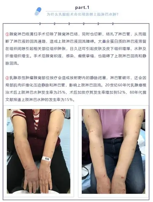 武汉市第一医院-乳腺癌术后上肢淋巴水肿家庭健康管理