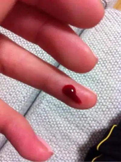 上海皮肤挫伤专家_上海治疗皮肤挫伤哪个专家好_上海治