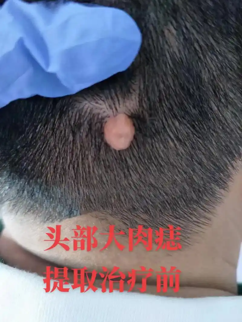 头部大肉痣提取治疗前头部大肉痣提取治疗中头部大肉