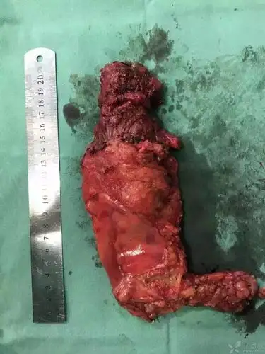 68岁,诊断直肠癌,今天在腹腔镜下低位直肠癌根治术(tme),术中出血10ml