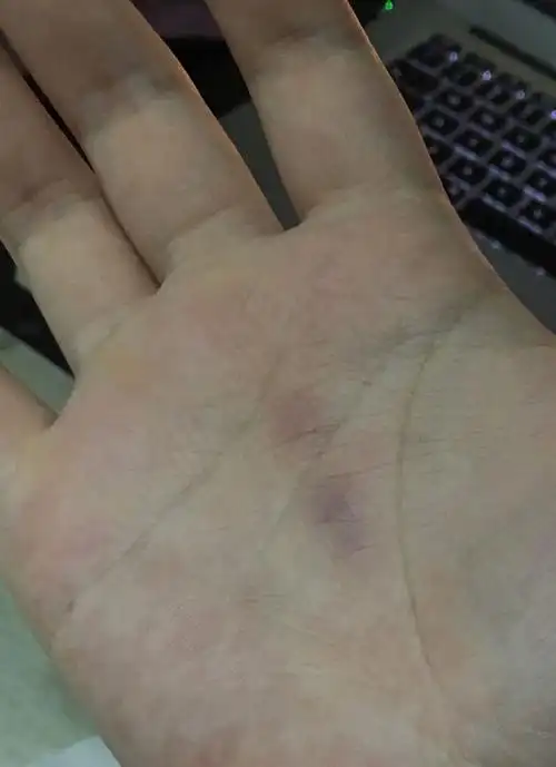 早上醒来手掌突然青了一块,摸上去有明显的突起和痛感,这是怎么啦!