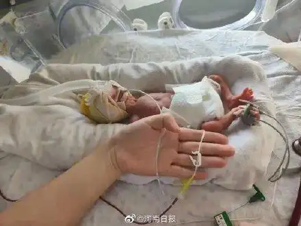 出生时只有1斤3两的宝宝出院啦