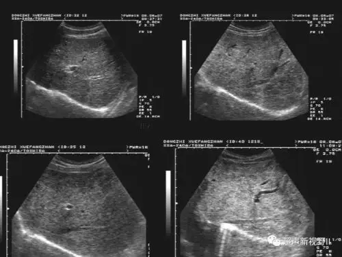 超声微课堂腹部超声肝硬化