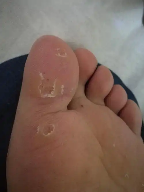 跖疣冷冻完结痂脱落后这样是痊愈了吗按着不硬也不疼了