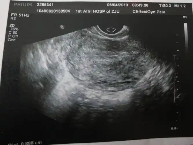 两次阴超,到底是何种病?(最新上传化验结果)