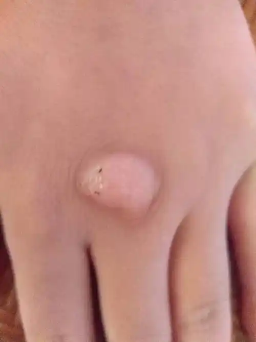 小孩子手背长了个硬硬的东西,没有肿块,单纯的如图上区域的皮肤变硬.