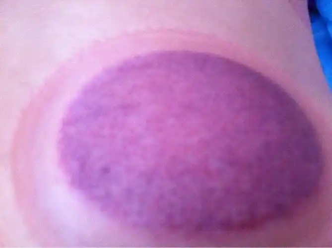 背部拔罐后,颜色如图,请问有什么说法.