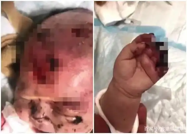 3月大女婴睡觉遭老鼠啃咬,头皮被吃掉一大片,骨头都露出来了