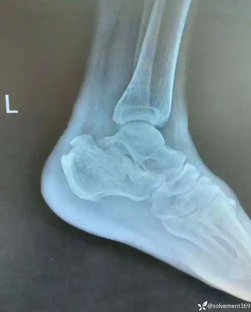 跟骨骨折差那么一点点