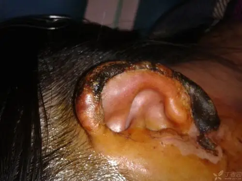 断耳再植术后17天,干痂仍未掉,怎么办?现在会不会发生耳廓软骨膜炎?