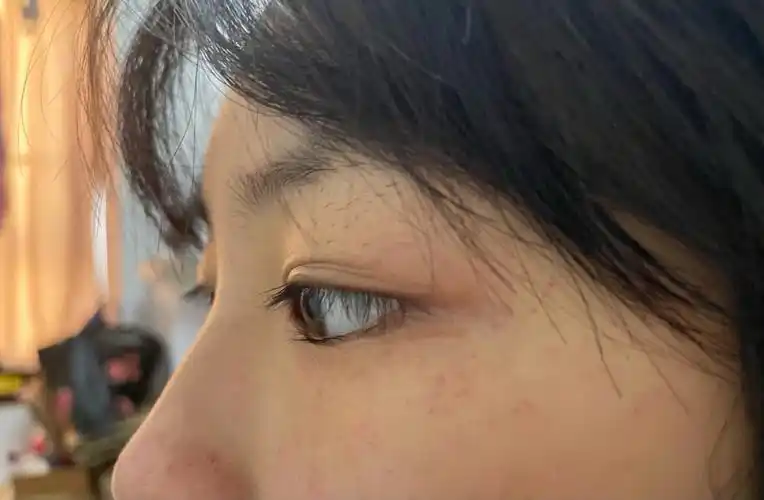 从小就是倒睫毛流眼泪看不了强光做完手术后真的很奈斯91