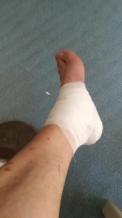 脚崴了,肿了,有么办法缓解疼痛啊