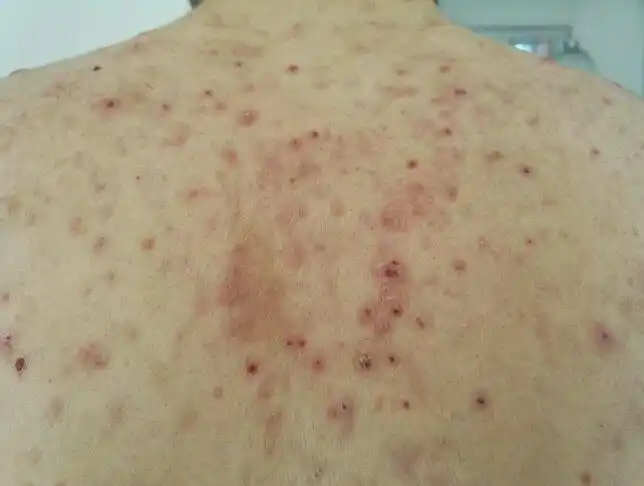 后背皮肤特别不好,请问怎么才能治好