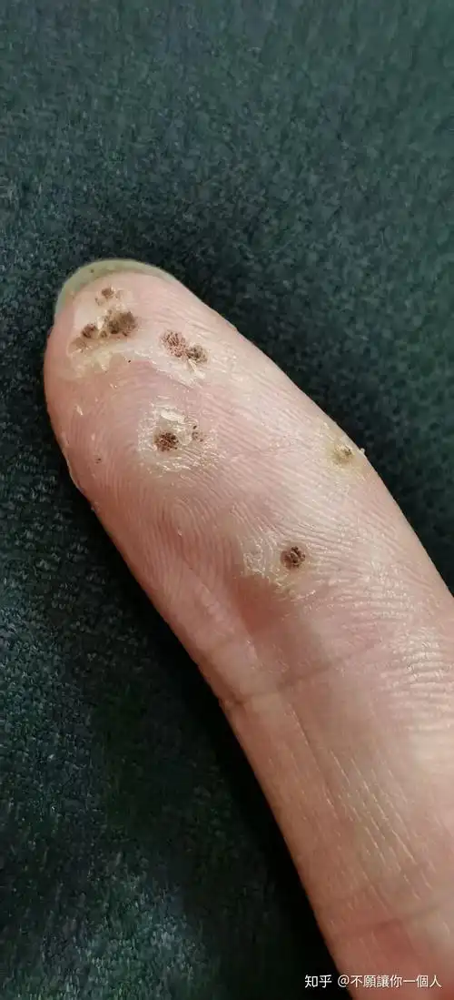 记录疣的治疗分享