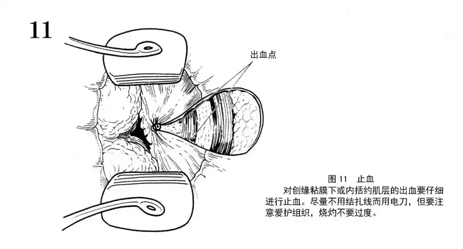 痔的基本术式--外剥内扎术图解