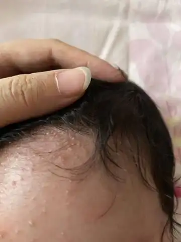 宝宝脸上和头上起了很多小红疙瘩,医生说是脂溢性皮炎,什么药也没给开