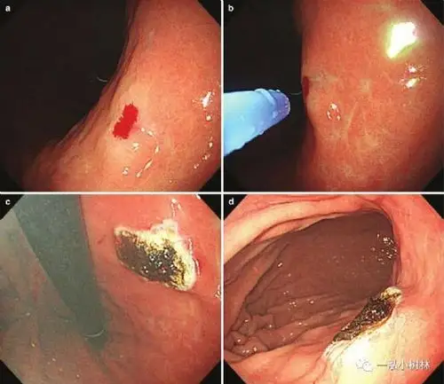 胃角良性溃疡伴喷射性出血,多个止血钳夹闭后无进一步出血,复查可见