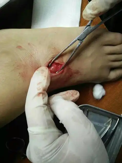 我脚背上的腱鞘囊肿动了手术才二个月又长了该怎么办,还压血脚神经,一