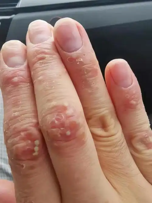 中医治疗手部顽固性湿疹 - 好大夫在线