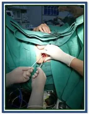 痔疮手术第一天:rph自动套扎微创体验