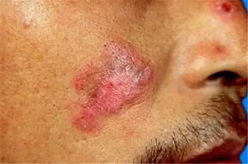 红斑狼疮早期手腕症状图片