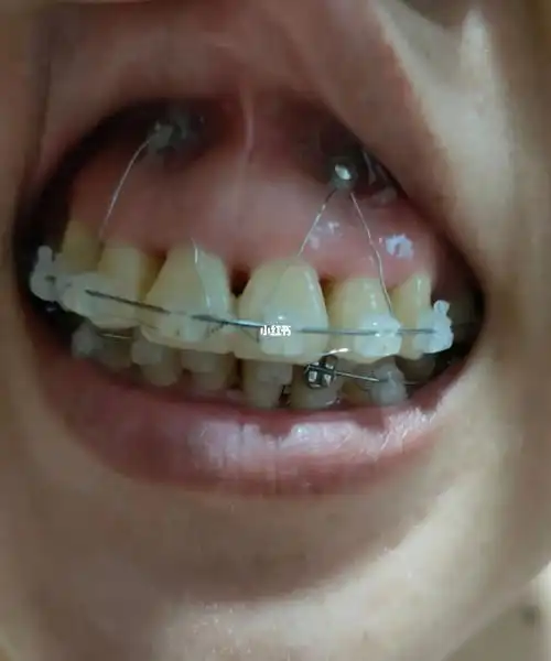 矫正牙齿骨钉 这啥我也不知道_骨钉_牙周炎_赛德阳光口腔自由行热门