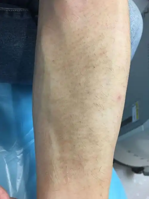 长毛又长斑-----色素毛表皮痣,becker痣的故事_痣_介绍_治疗方式 - 好