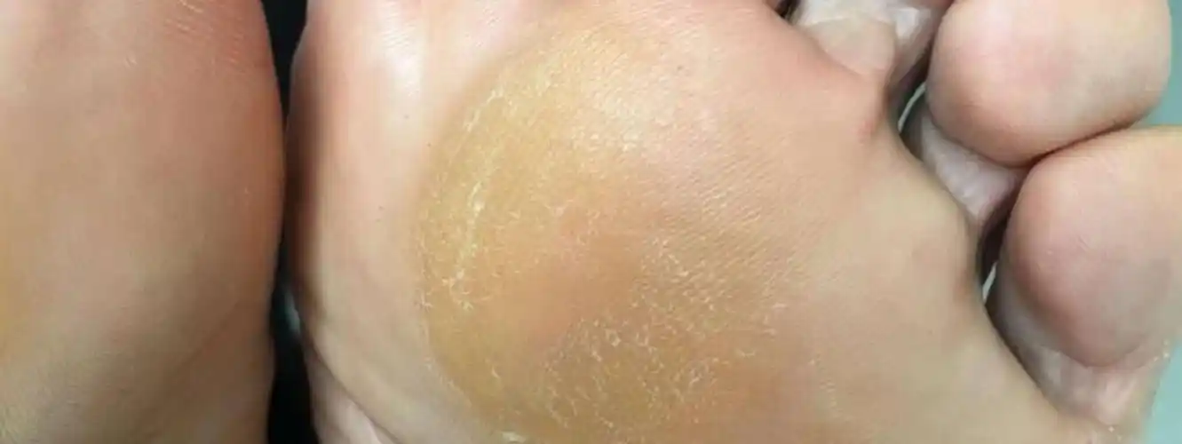 脚垫也叫胼胝 (pian zhi),但与骗子无关!