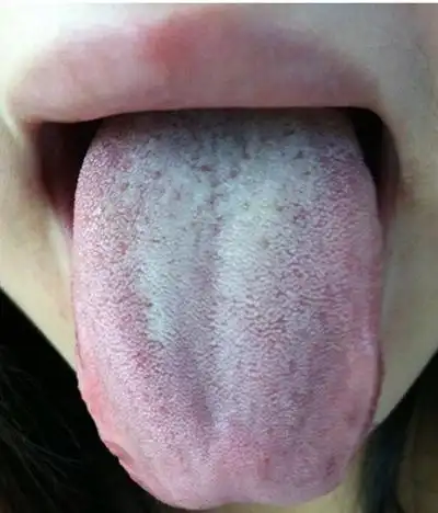 舌头白斑图片62