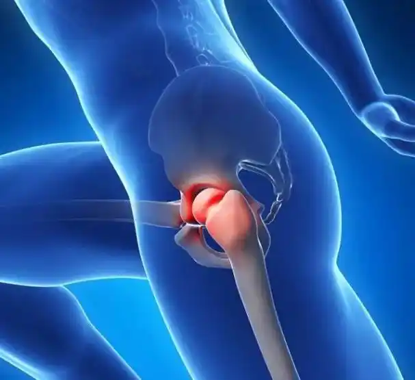 最容易被忽视的髋部疼痛疾病髋关节撞击综合症